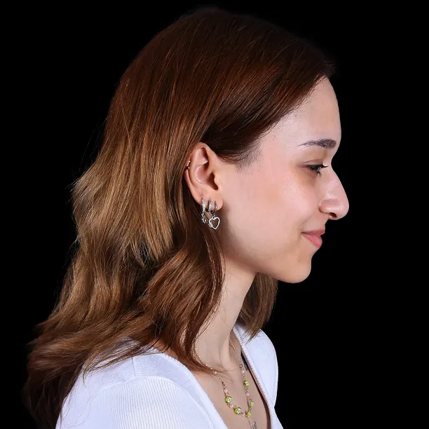 Resultado Rinoplastia - Antes