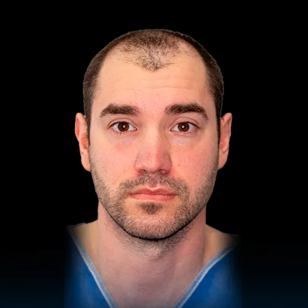 Resultado Trasplante Capilar - Antes