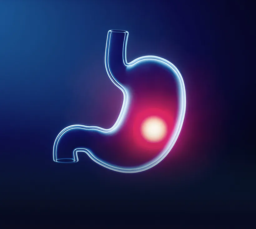 Cirugía Bariátrica