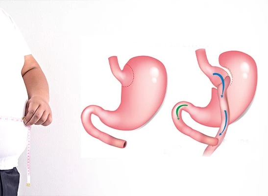 Bypass Gástrico