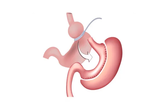 Revisión Bariátrica