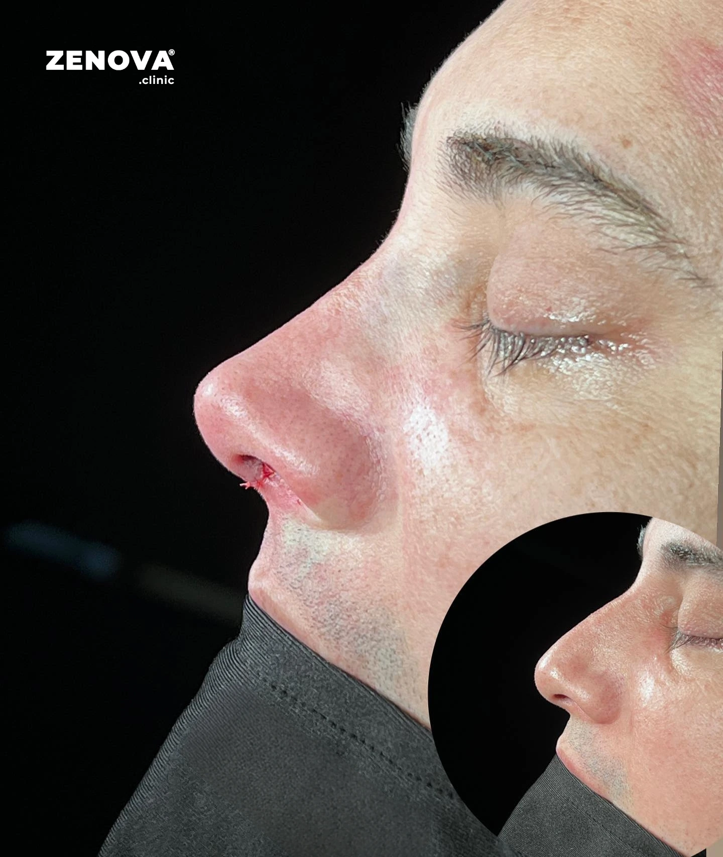 Rinoplastia en Turquía