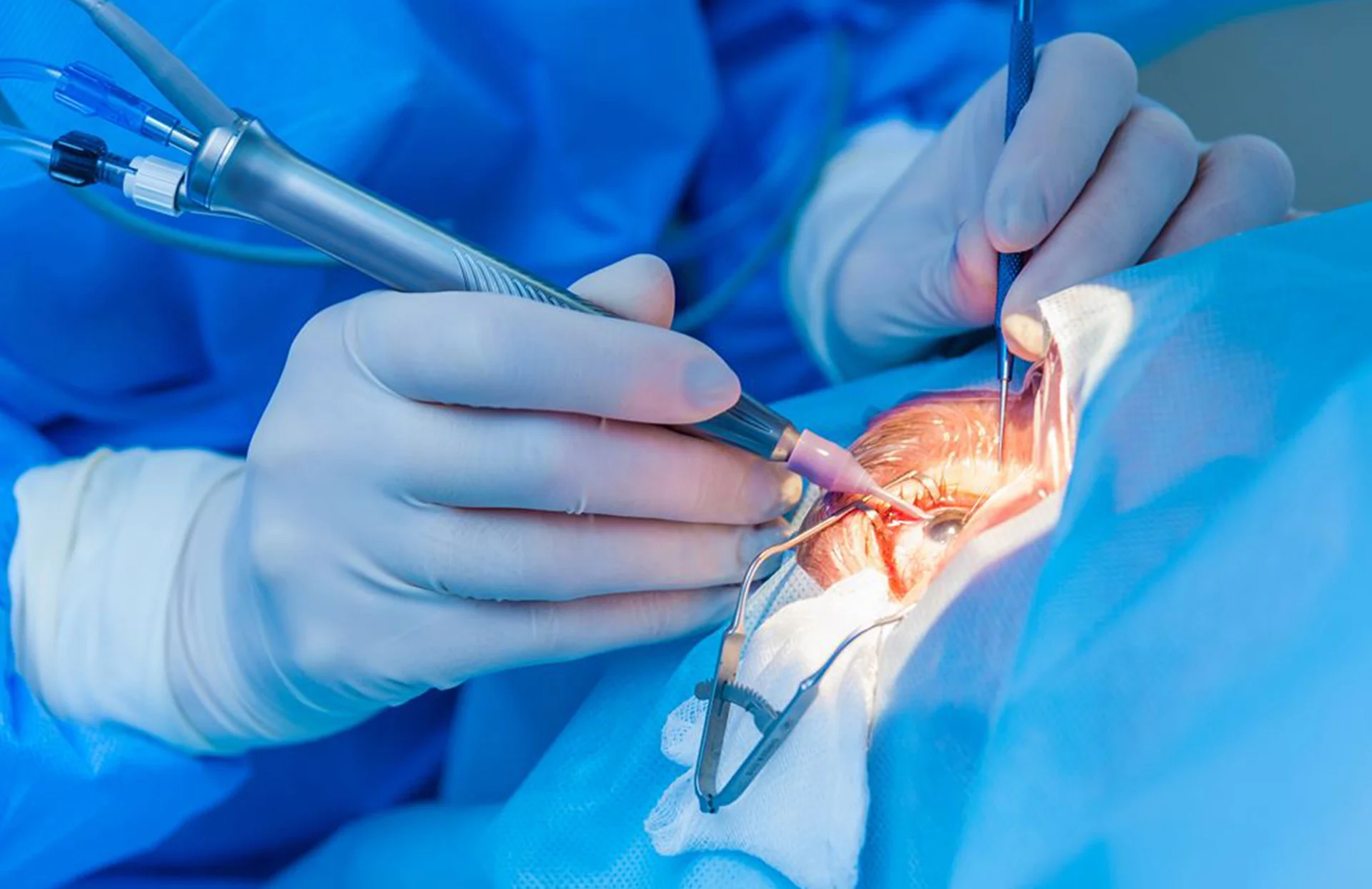 Cirugía de Cataratas Turquía