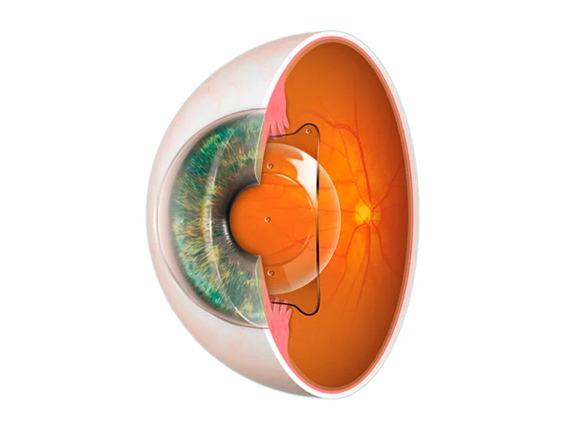 Lentes Intraoculares ICL Turquía