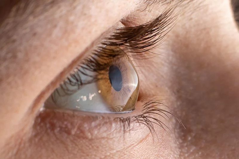 Tratamiento de Queratocono en Turquía