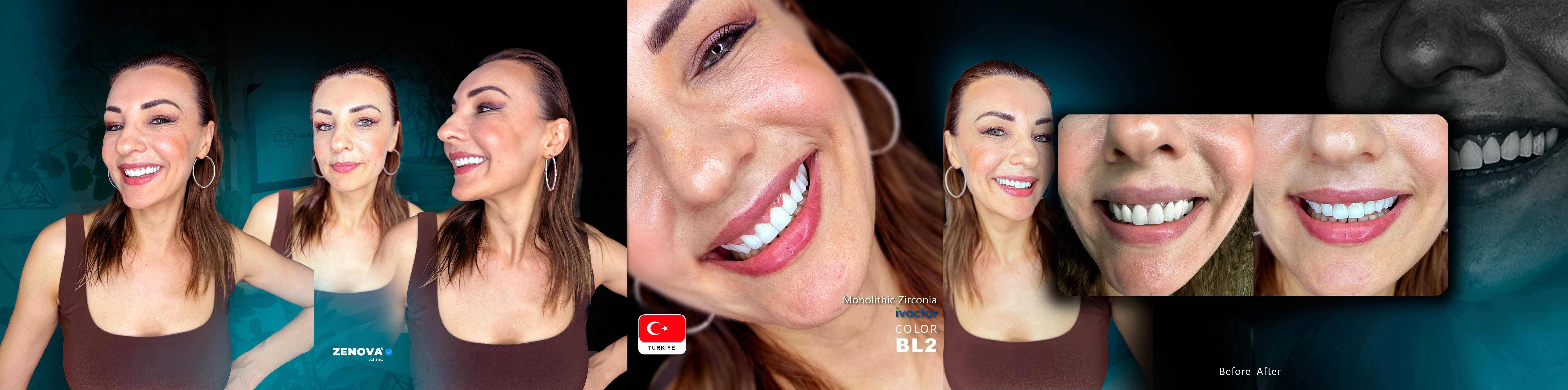 Clínica Dental en Turquía - Zenova Clinic Estambul