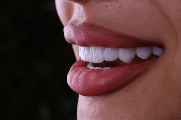 Carillas Dentales en Turquía