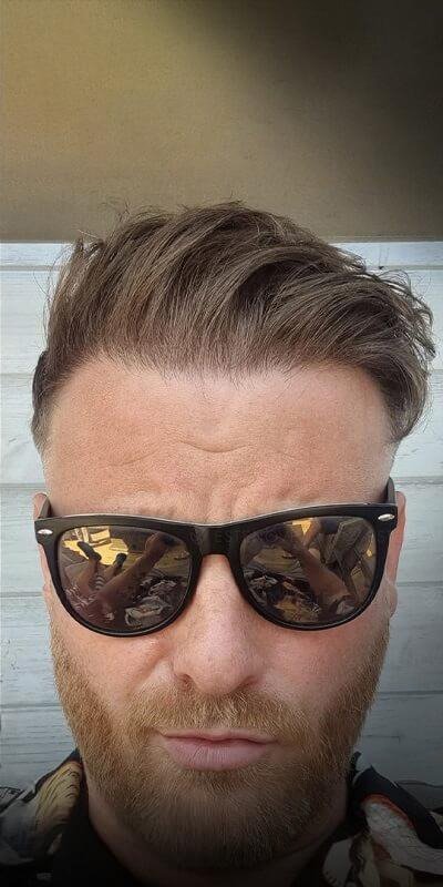 Foto después del trasplante capilar