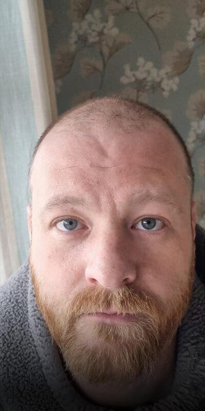 Foto antes del trasplante capilar