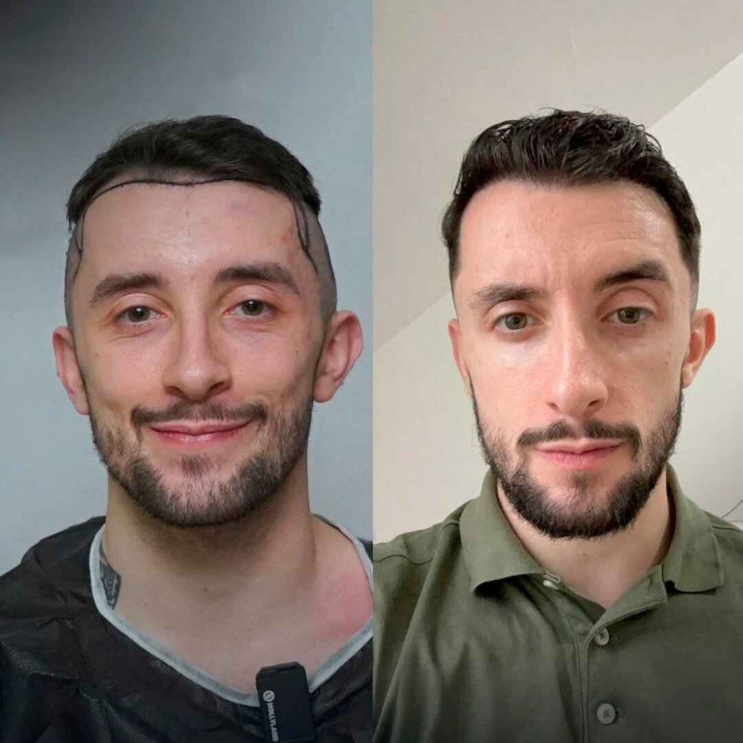 Comparación antes y después del caso 2