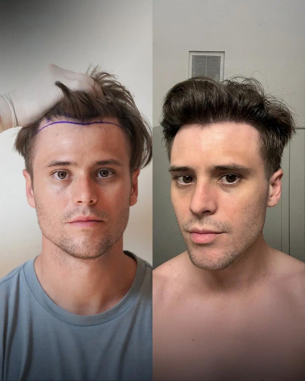 Comparación antes y después del caso 4