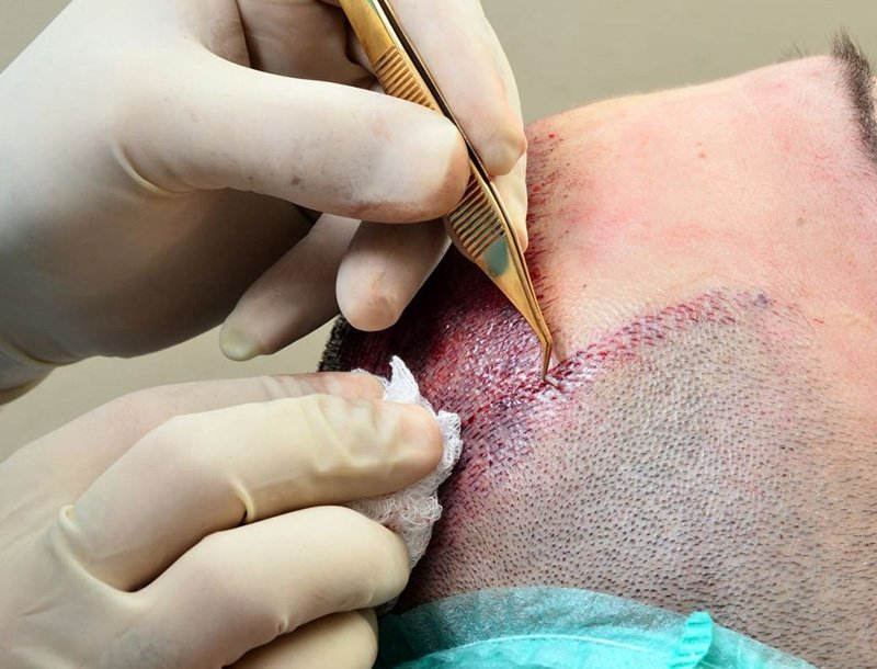 FUE en Zenova Clinic